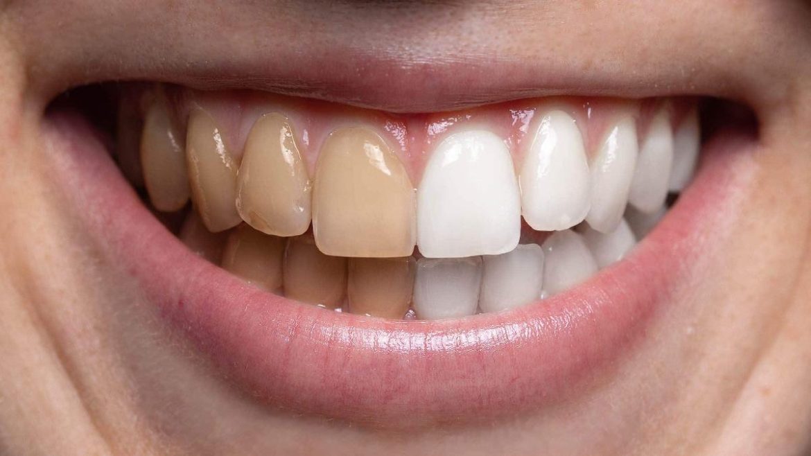 cette-astuce-pour-blanchir-les-dents-en-2-minutes-va-vous-surprendre-par-son-efficacite cette-astuce-pour-blanchir-les-dents-en-2-minutes-va-vous-surprendre-par-son-efficacite